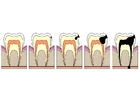 Afbeeldingen evolutie tandbederf
