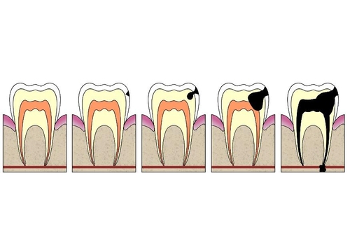 evolutie tandbederf