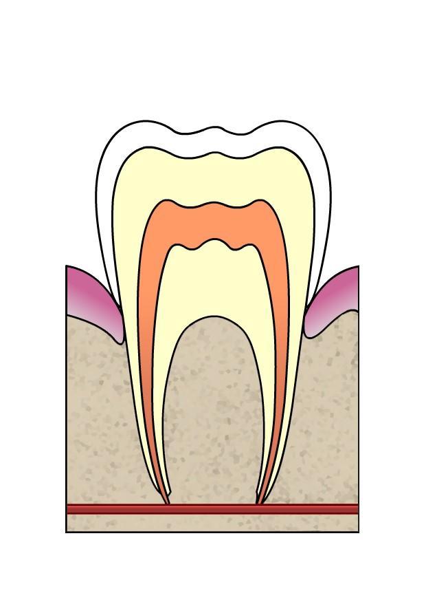 Afbeelding evolutie tandbederf 1