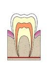 Afbeelding evolutie tandbederf 1