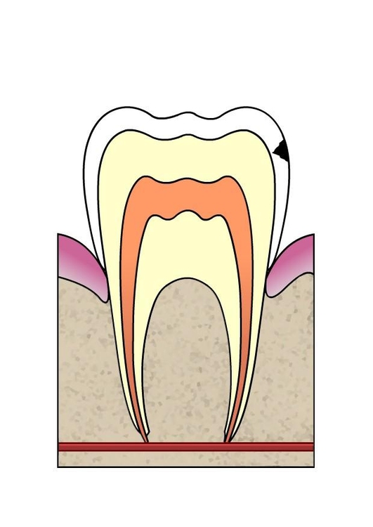 Afbeelding evolutie tandbederf 2
