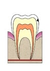 Afbeelding evolutie tandbederf 2