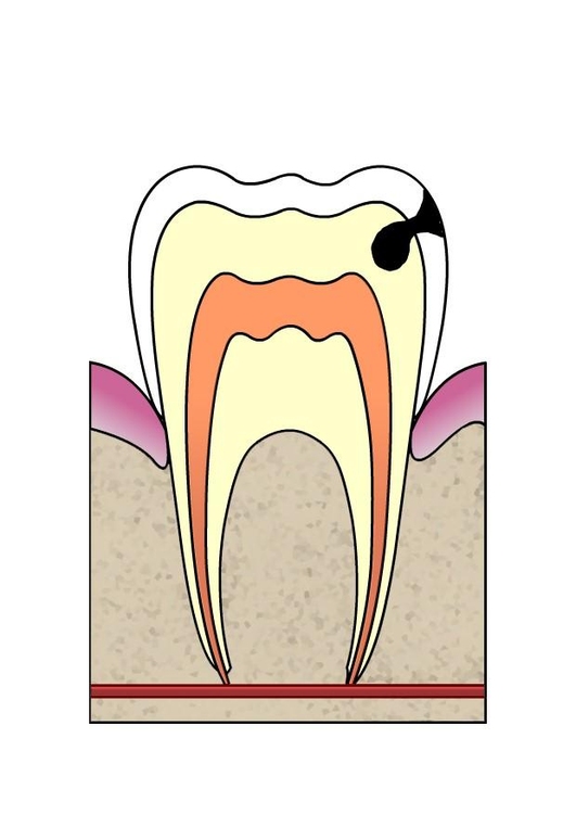 Afbeelding evolutie tandbederf 3