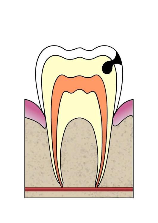 evolutie tandbederf 3
