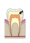 Afbeeldingen evolutie tandbederf 3