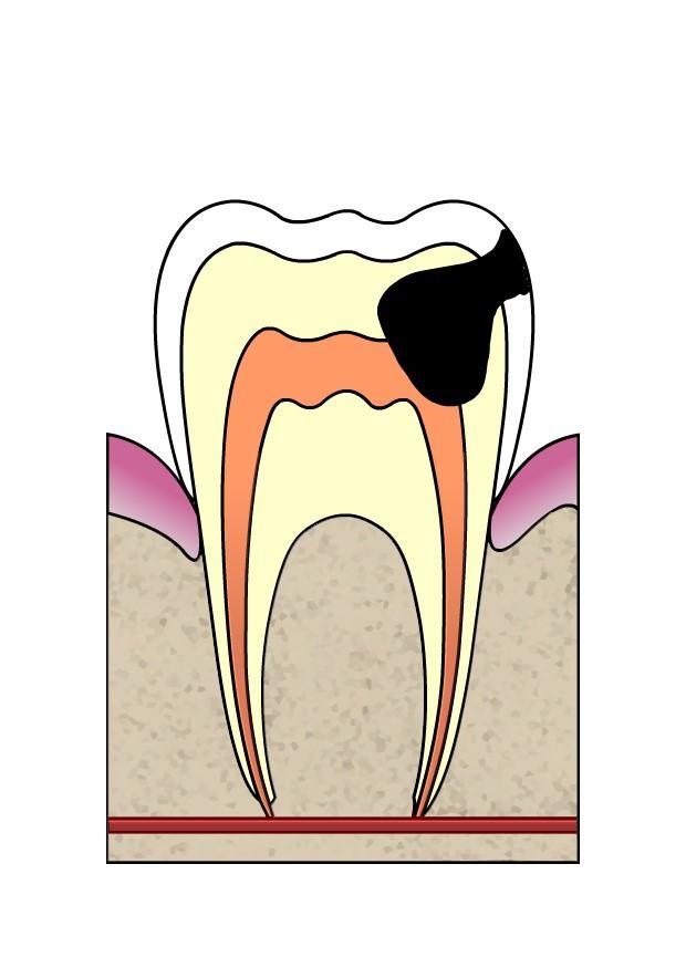 Afbeelding evolutie tandbederf 4