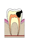 Afbeelding evolutie tandbederf 4