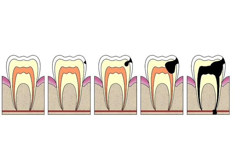 Afbeelding evolutie tandbederf