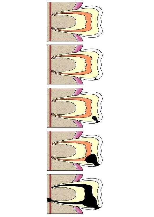 evolutie tandbederf