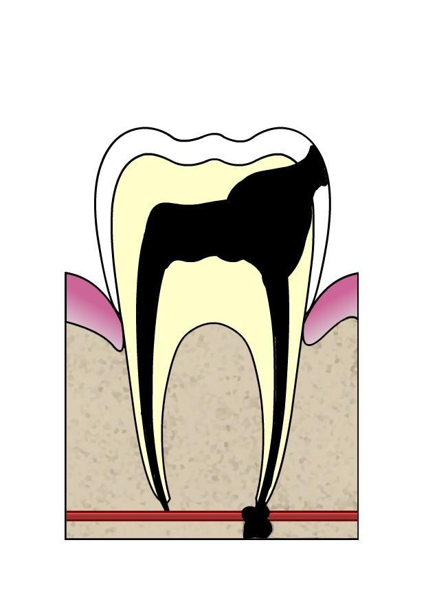 evolutie tandbederf 5 Afbeelding evolutie tandbederf 5